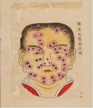 天然痘の発症