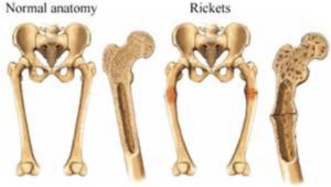 くる病の脊椎や四肢骨の湾曲や変形